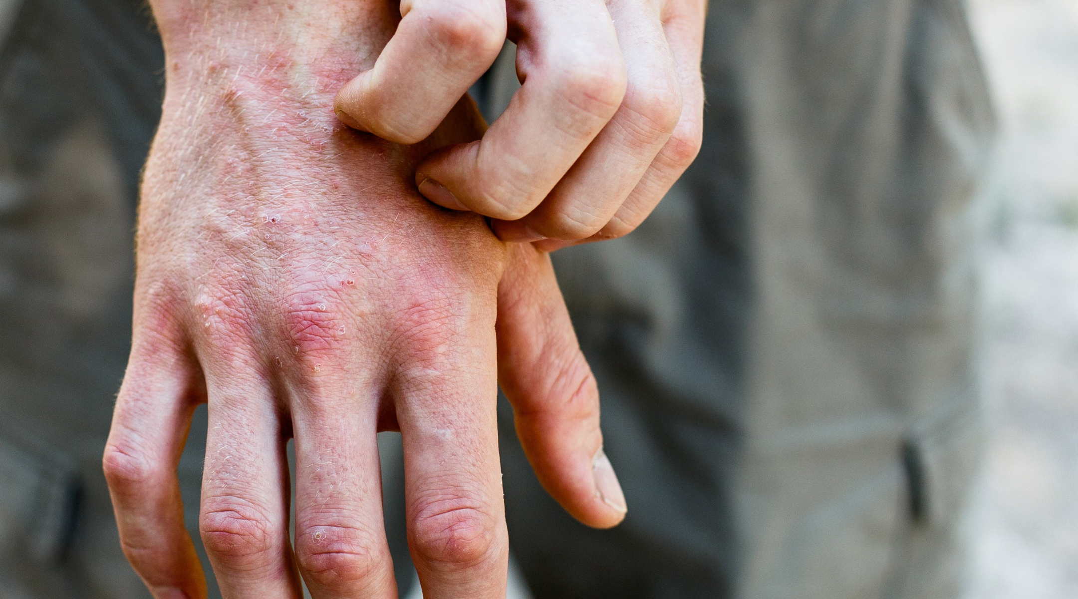 Managing Eczema Flare-Ups