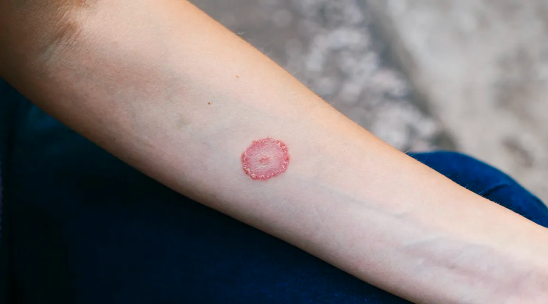 Understanding Discoid Eczema Grahams Natural UK