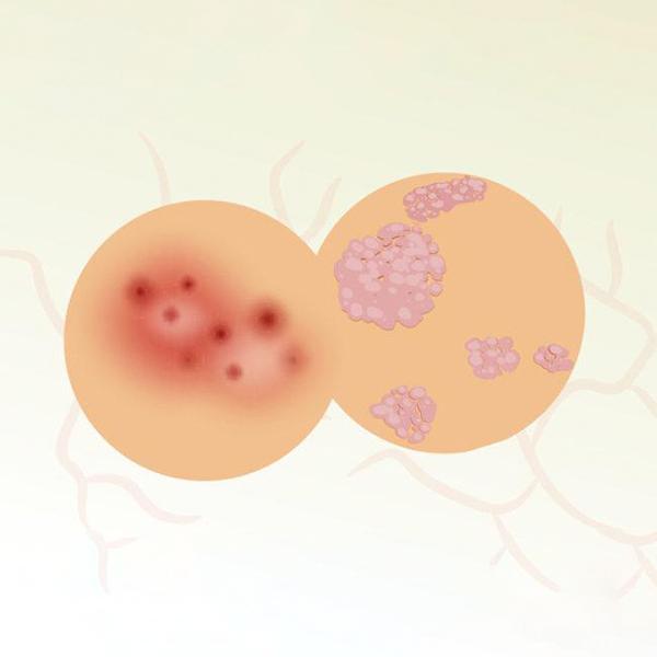 Psoriasis VS Eczema. What is the Difference?