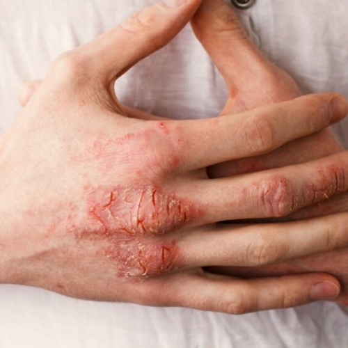 Eczema causes discount