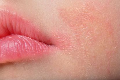 Why your Eczema gets worse when the season changes