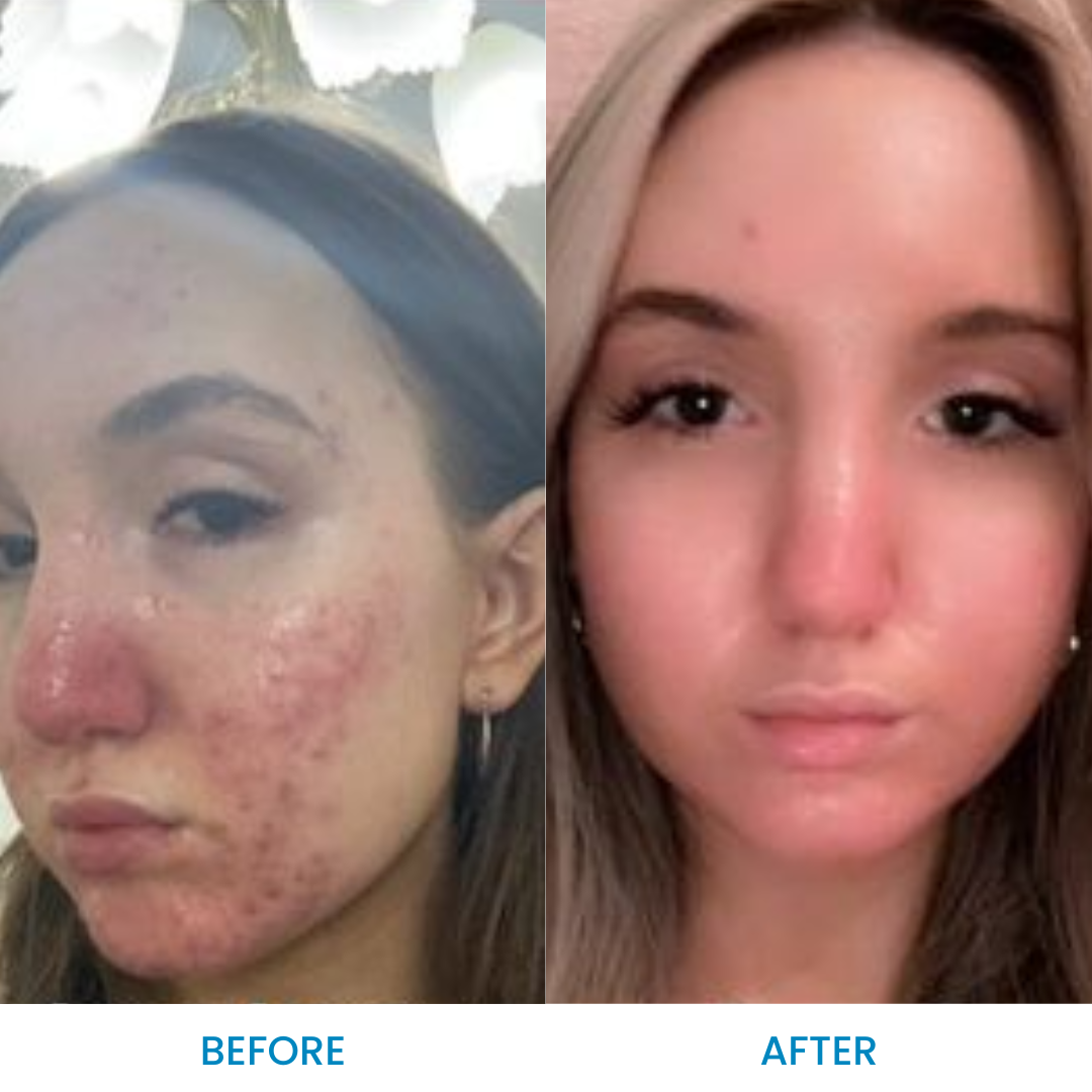 Seborrheic Dermatitis Pack