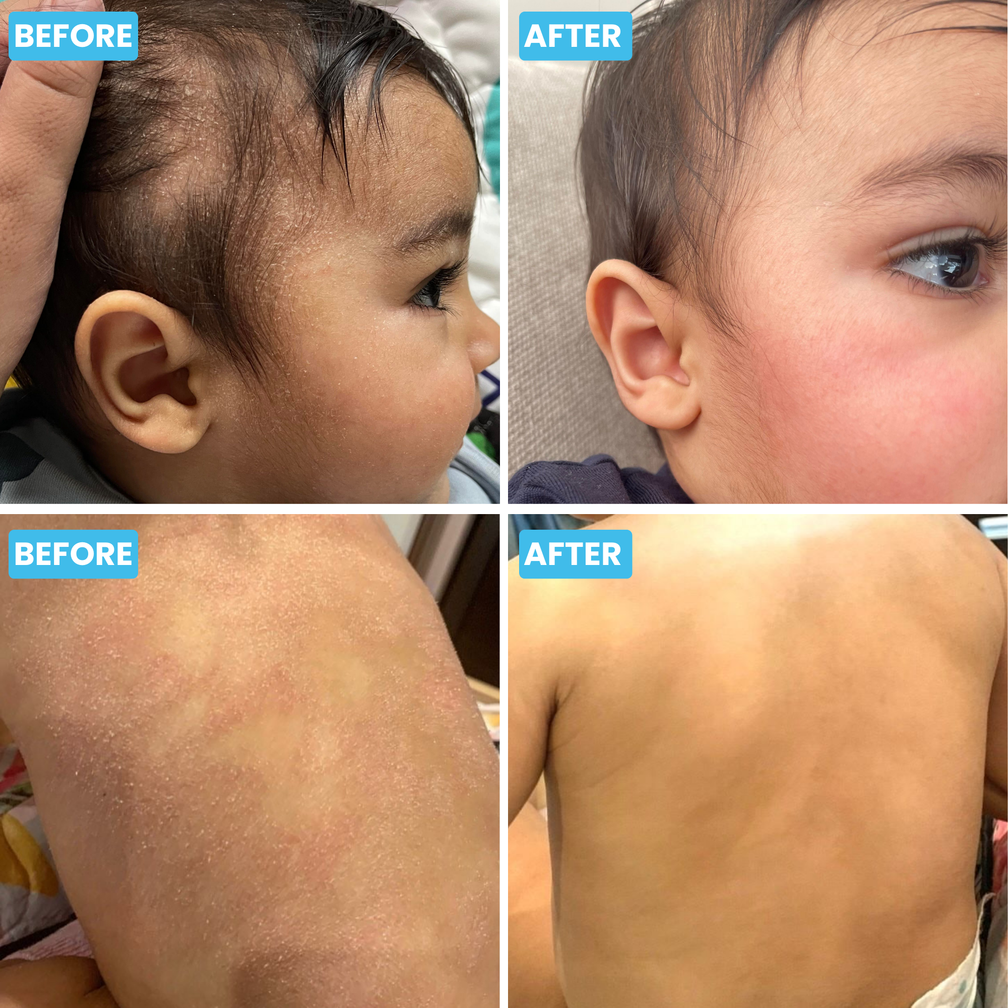 Baby Eczema Body & Bath Oil