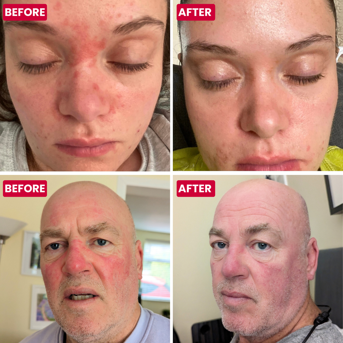 Rosacea Relief Pack