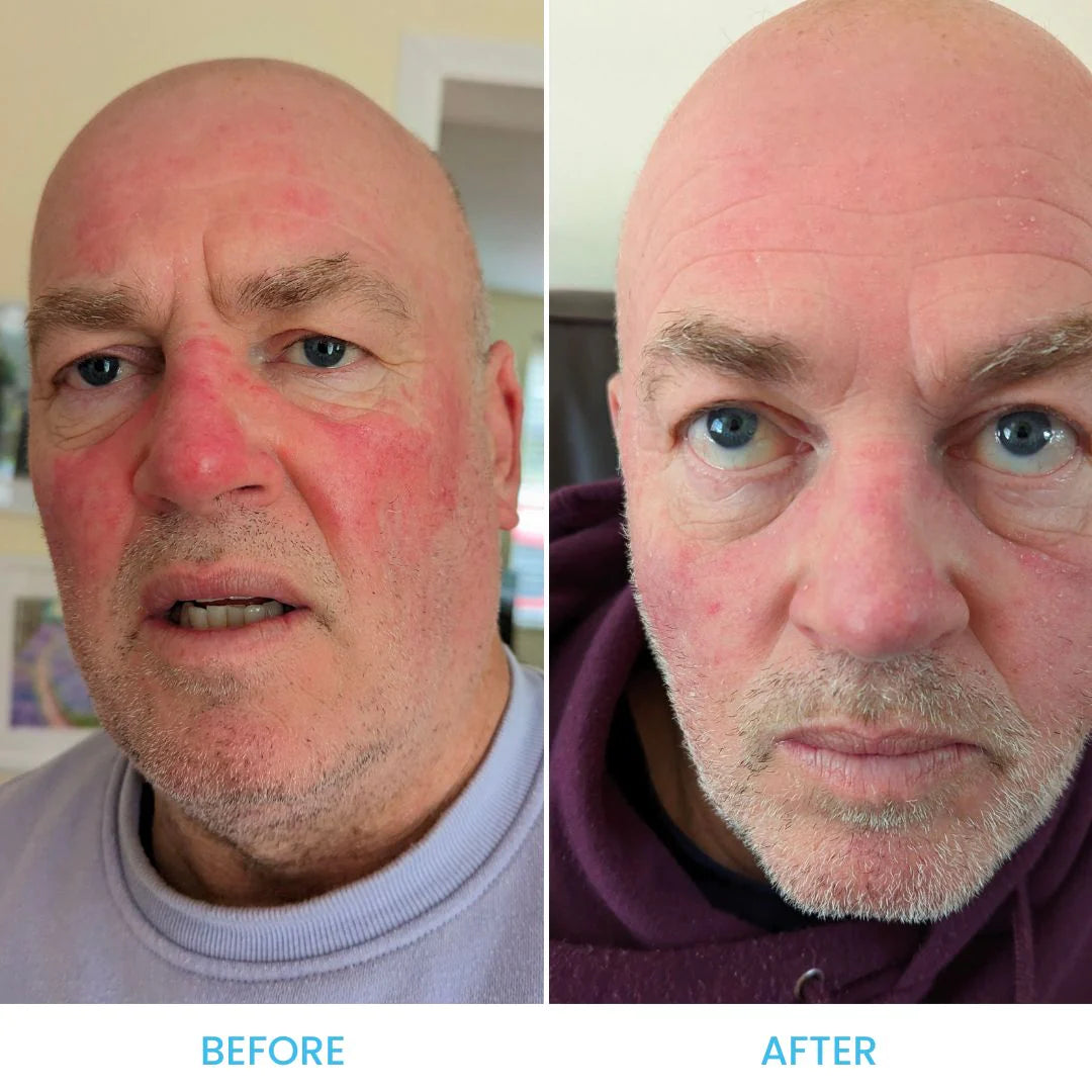 Rosacea Essential Pack