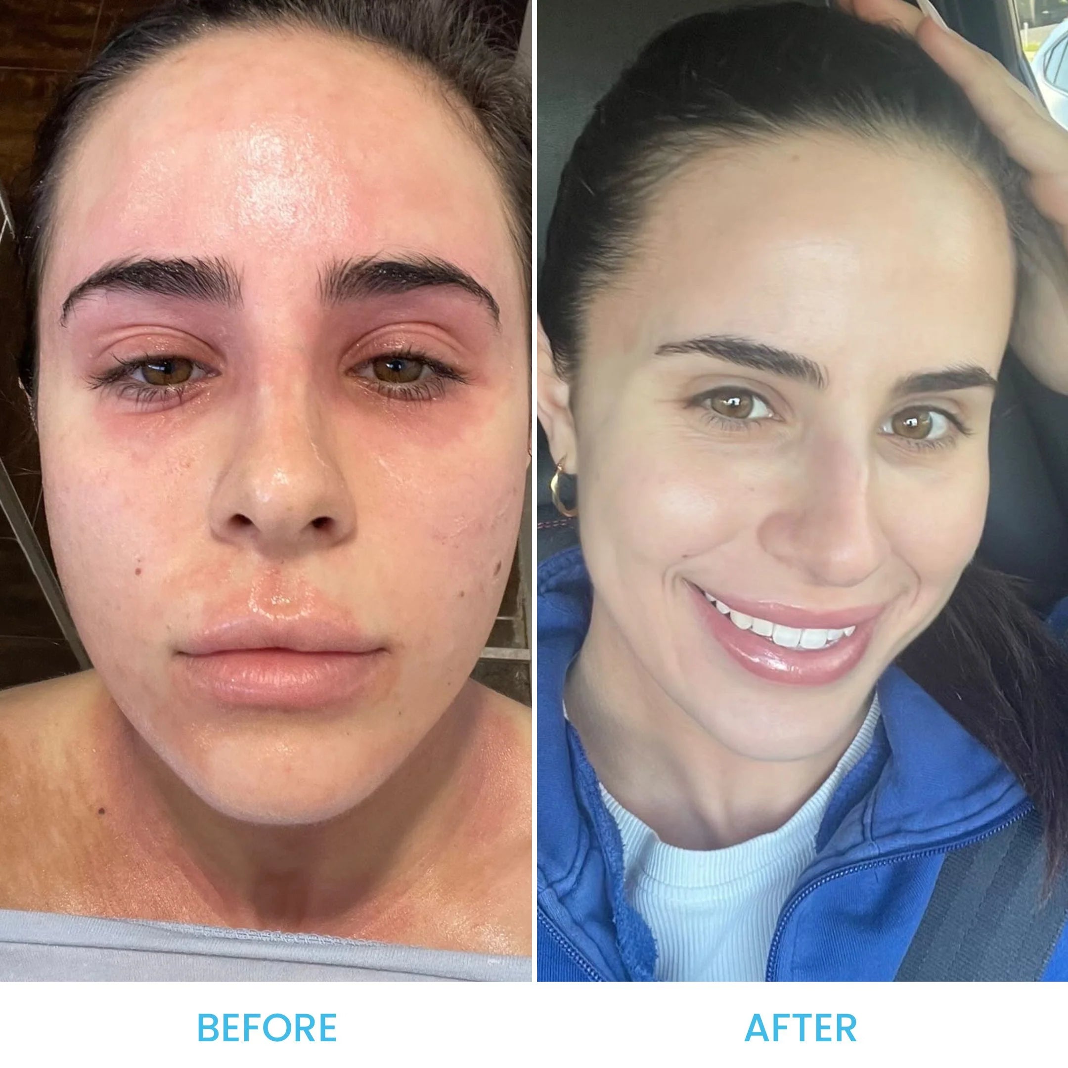 Face & Eyelid Eczema Cream