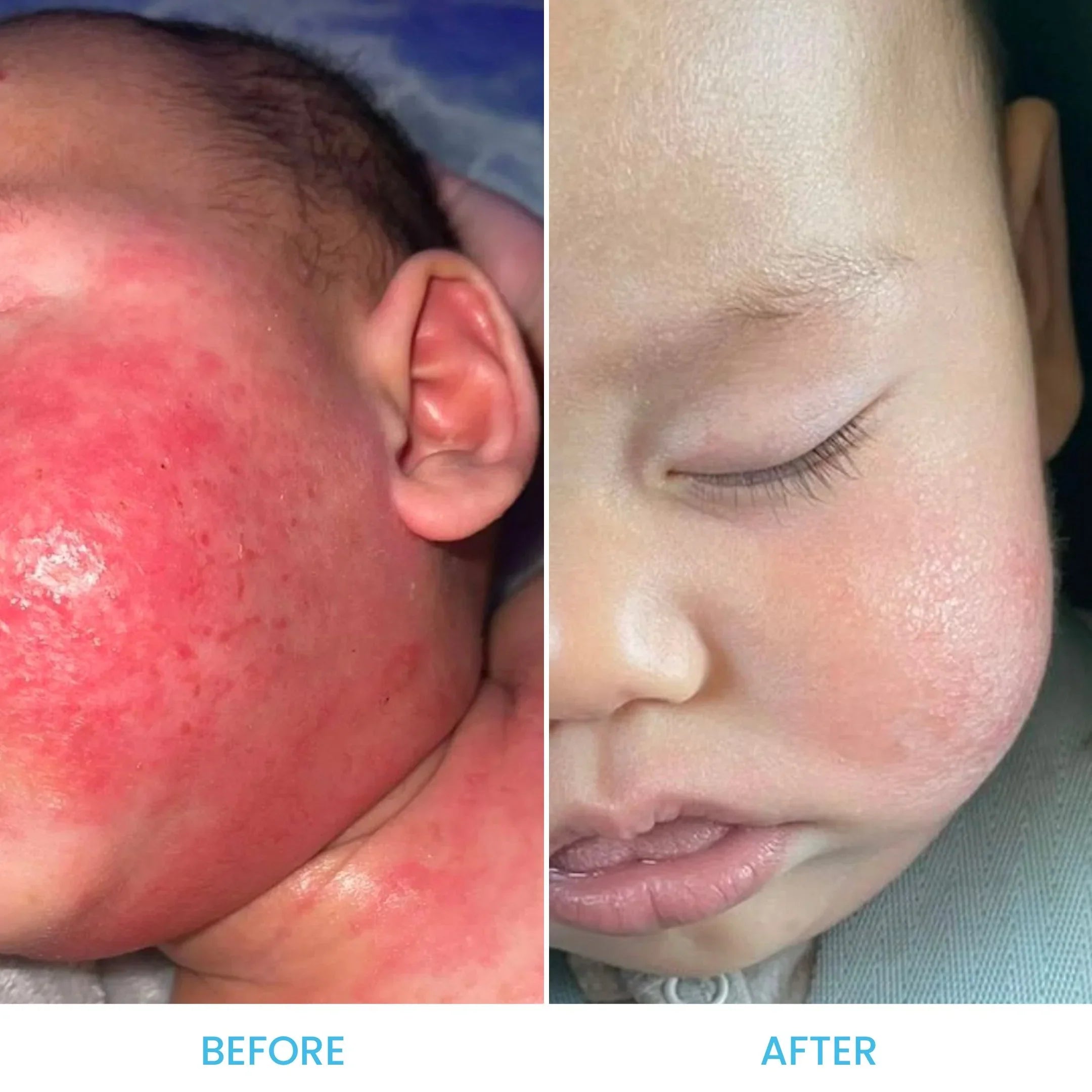 Baby Eczema Pack