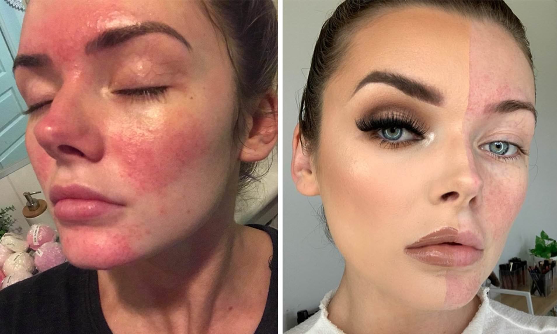 Makeup Tips for Rosacea-Prone Skin