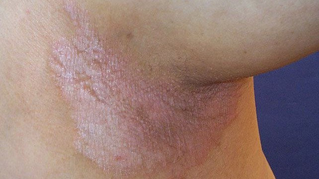 Hidden But Painful Skin Folds: Inverse Psoriasis