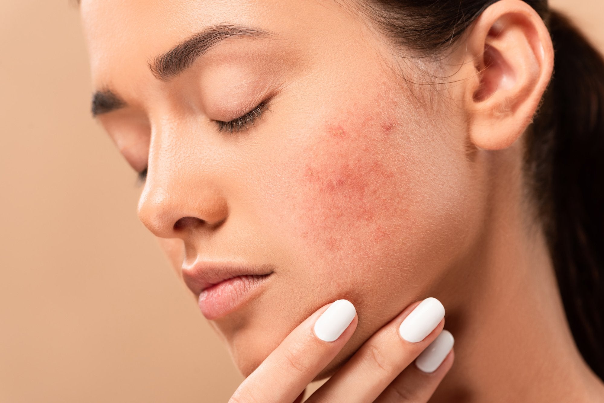 Dealing with Adult Acne