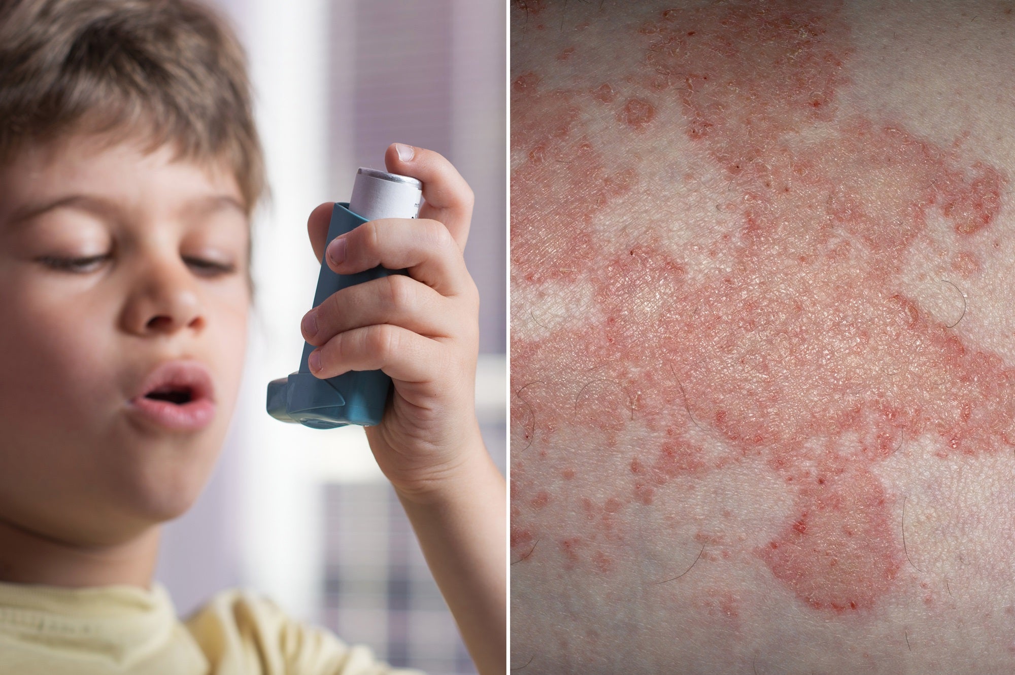 The link between Eczema and Asthma