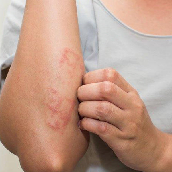 Atopic Dermatitis- What is it and how to treat it