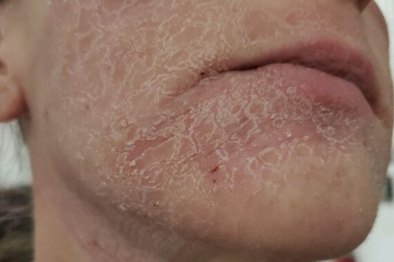 Hot To: Topical Steroid Withdrawal