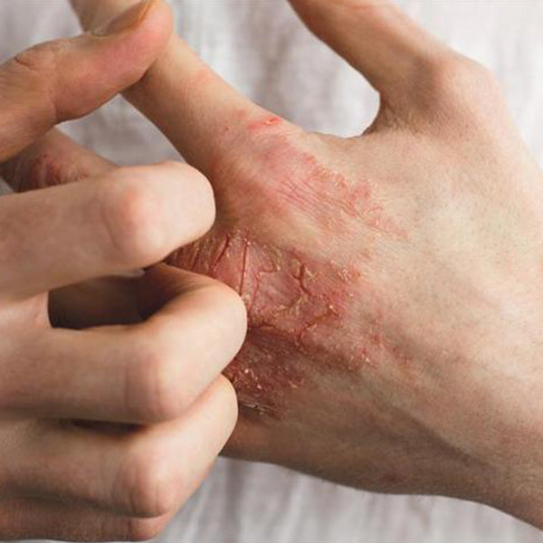 Eczema on the hands, and how to treat it!