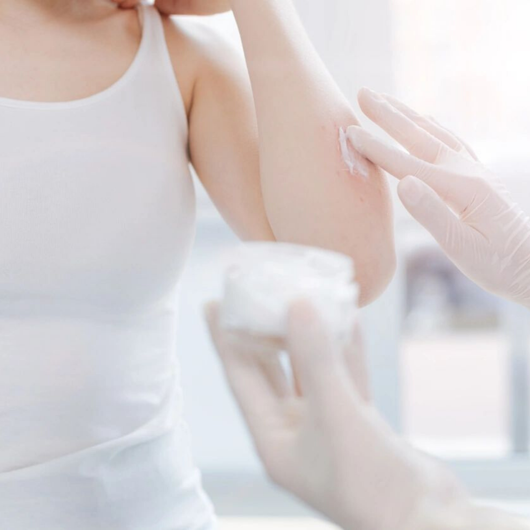 Managing Psoriasis in Winter