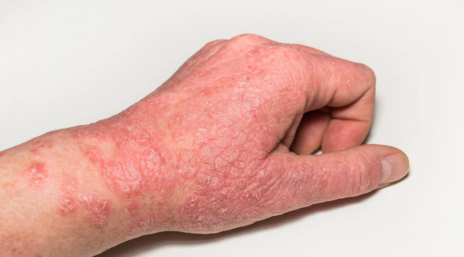Is Eczema Contagious? Debunking Common Myths