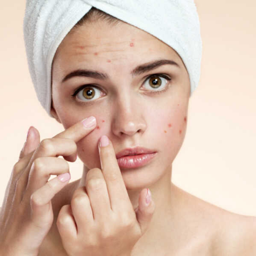 5 Triggers that could be making your Acne Worse – Grahams Natural UK