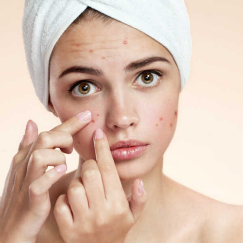 5 Triggers that could be making your Acne Worse