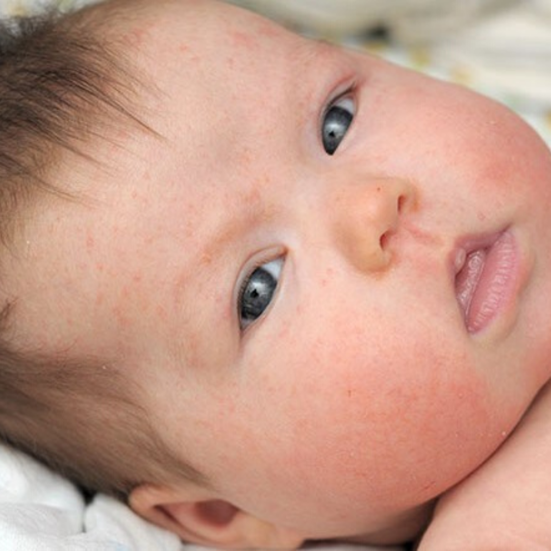 Baby Eczema Cream