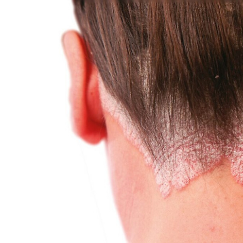 Dry Scalp? You May have Scalp Psoriasis