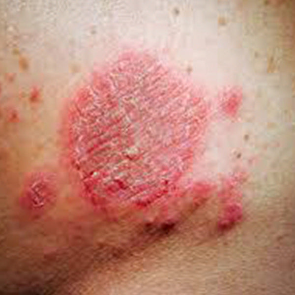What causes nummular eczema? And how to treat it?