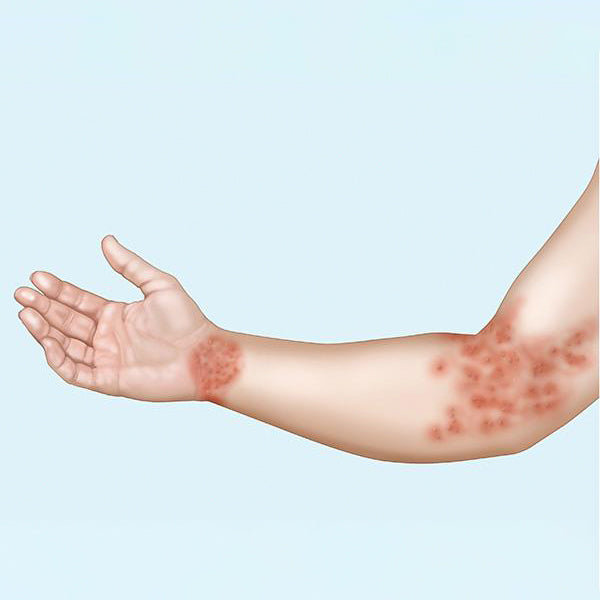 What is Discoid Eczema? And How to Treat it?