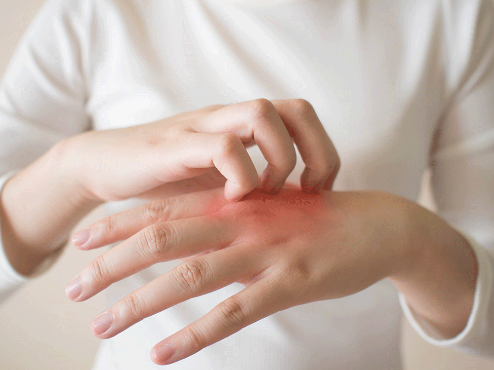 Avoiding eczema flare-ups in winter: Graham’s top five tips
