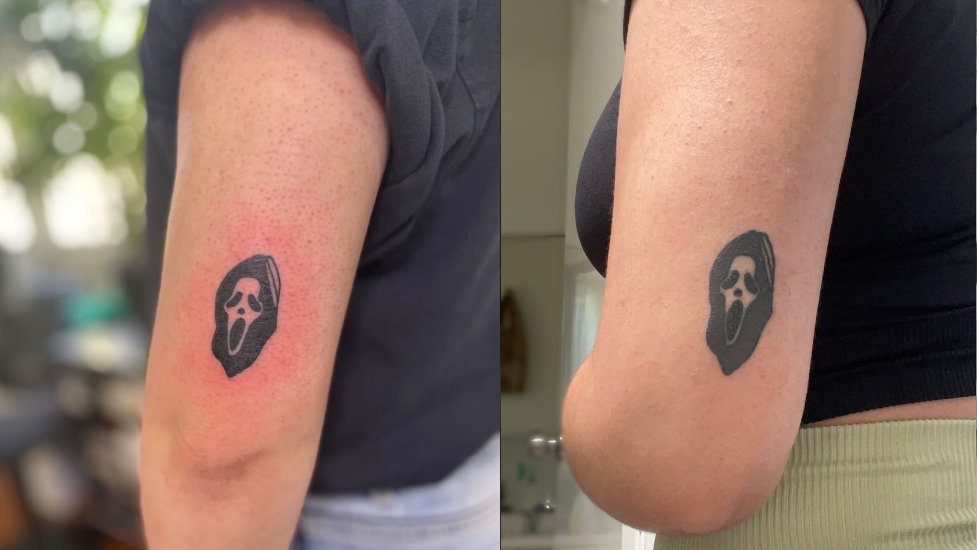 Understanding Keratosis Pilaris (KP): Causes, Symptoms & How to Smooth Your Skin Naturally