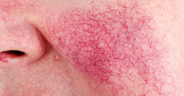 What Could be Triggering your Rosacea?