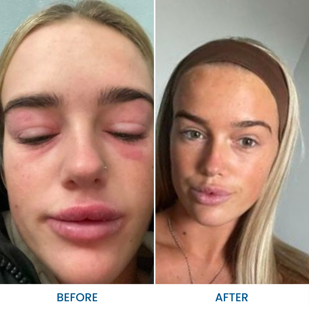 Face Eczema Pack