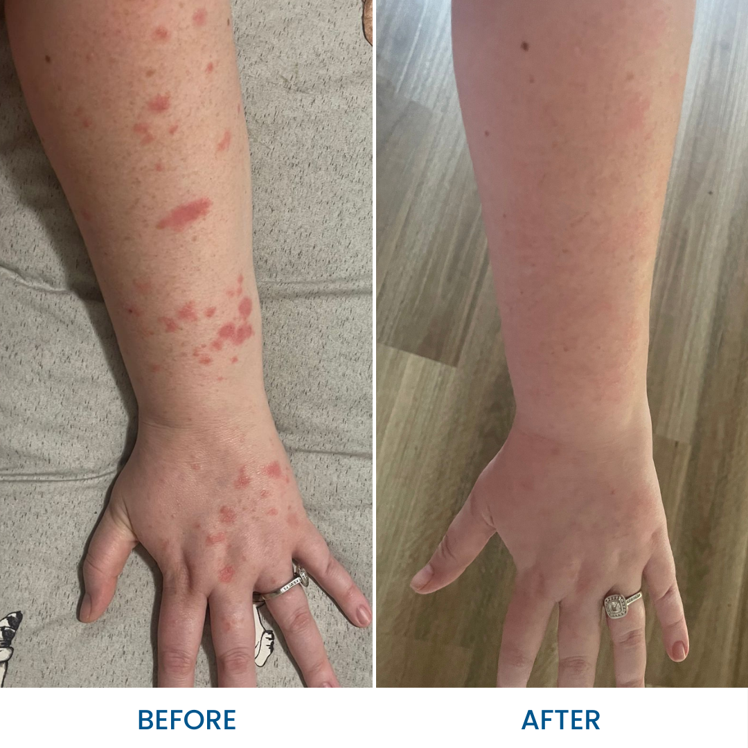 Psoriasis Cream