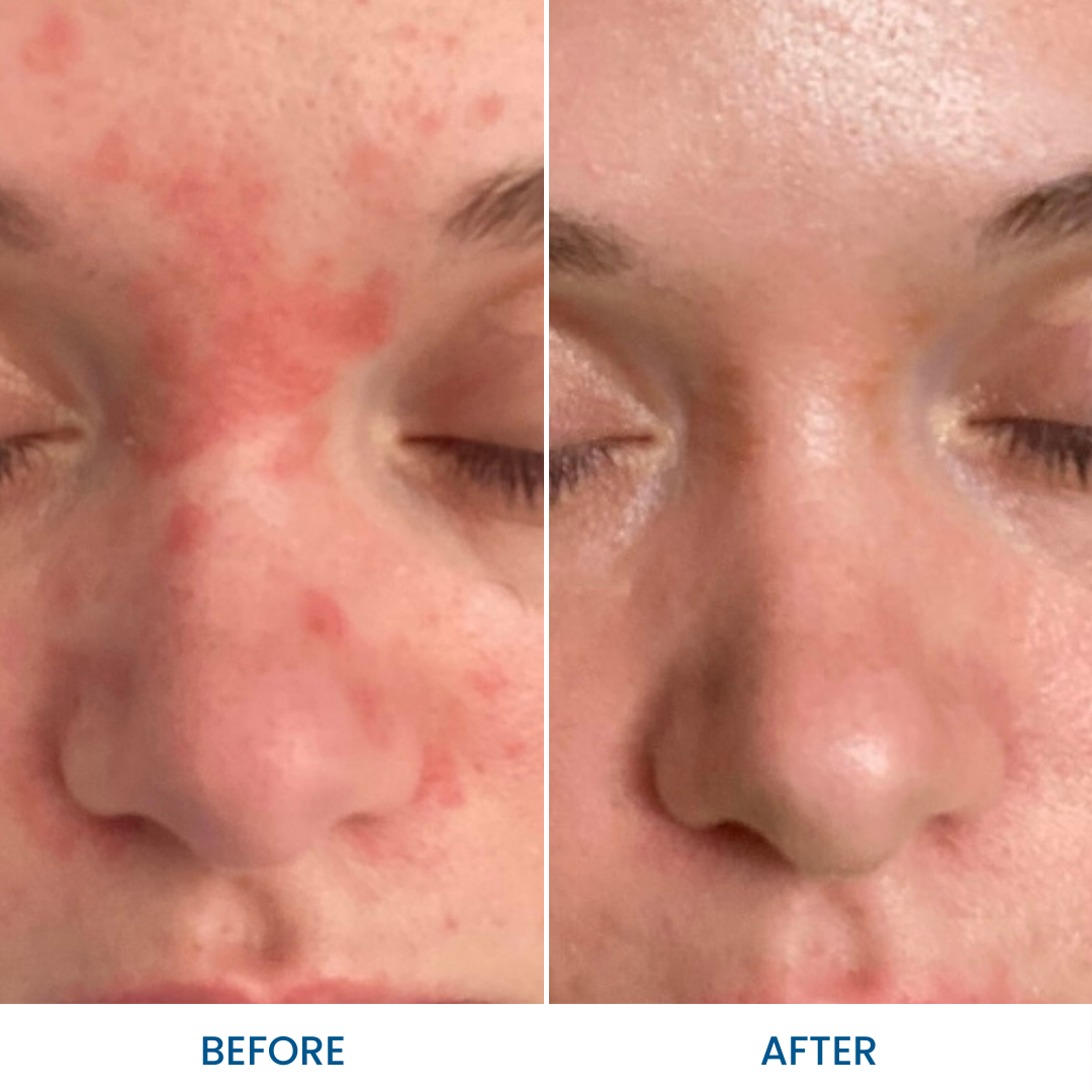 Rosacea Cream