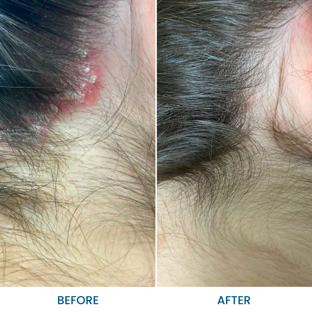 Scalp Psoriasis Pack