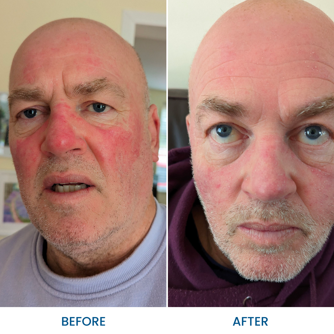 Rosacea Relief Pack