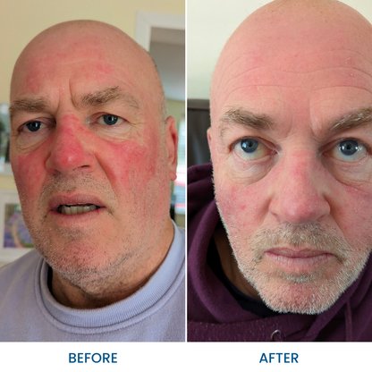 Rosacea Essential Pack