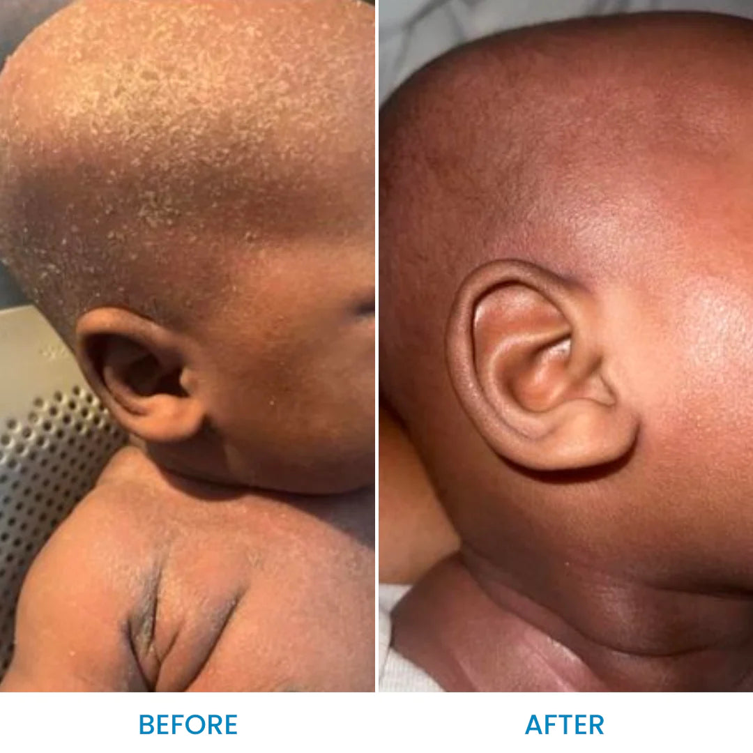 Baby Eczema Body & Bath Oil