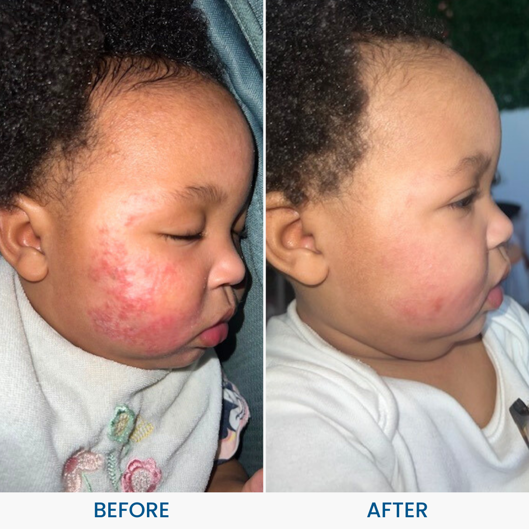 Natural Baby Eczema Cream