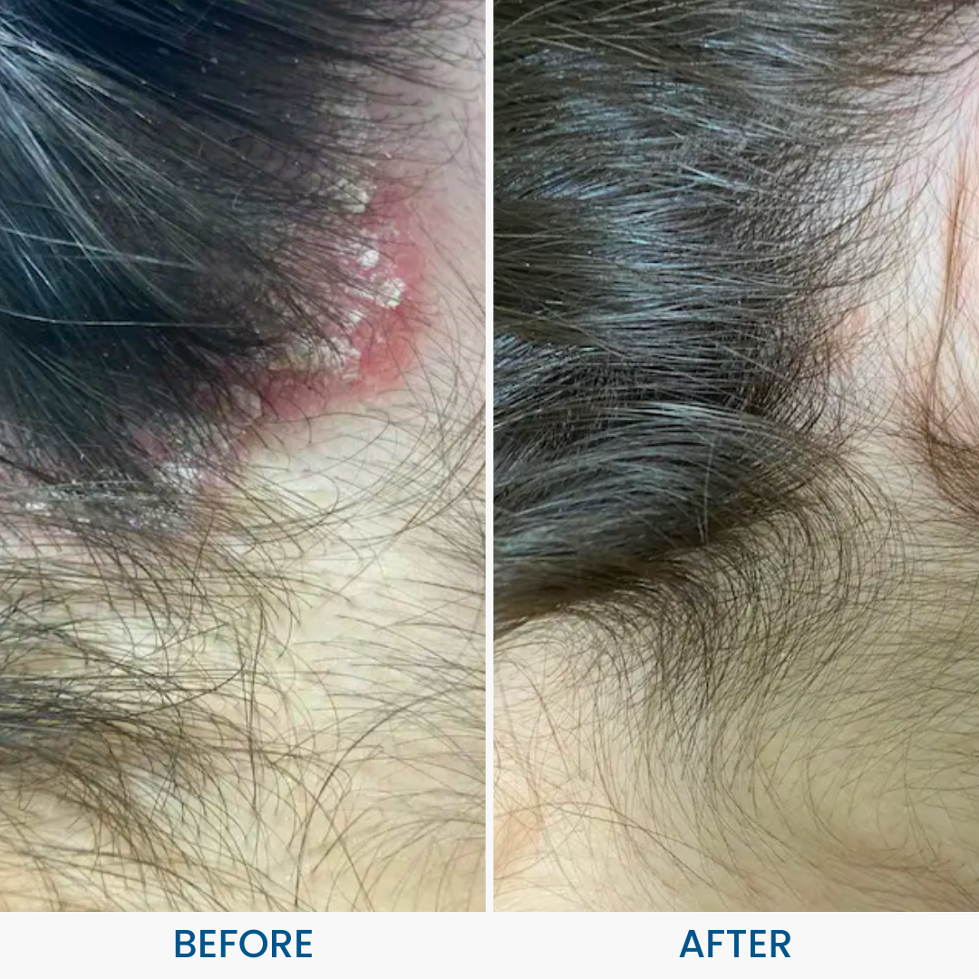 Scalp Psoriasis Pack