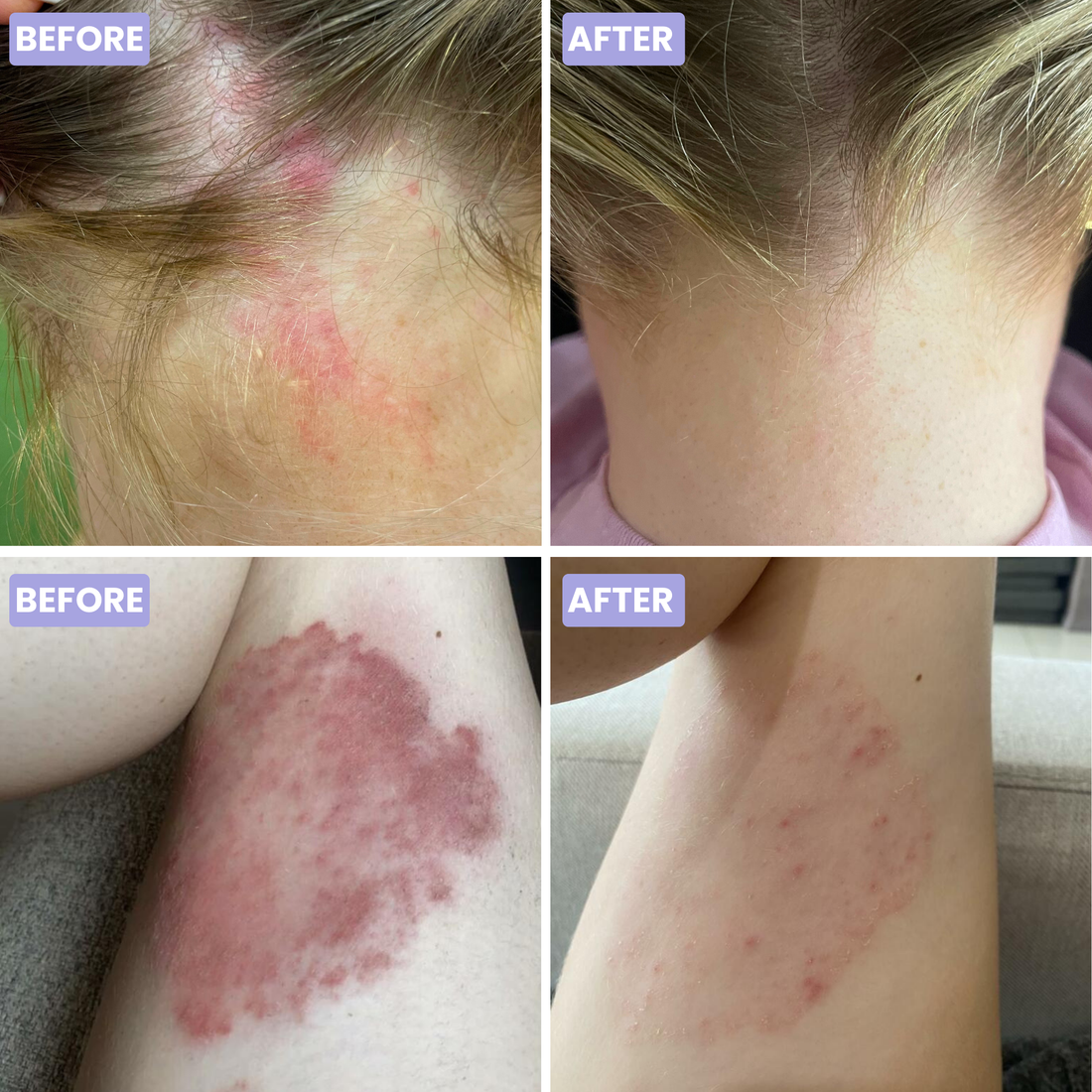 Ultimate Psoriasis Pack