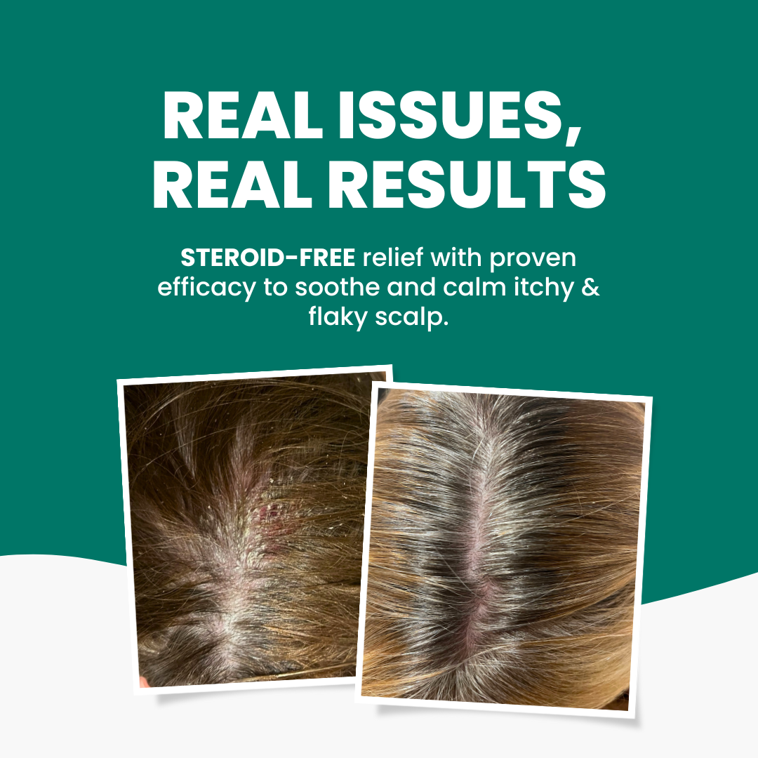 Scalp Psoriasis Pack